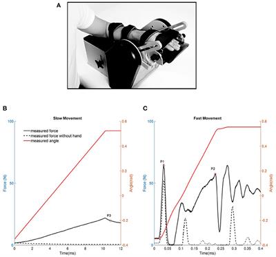 Changes in the Neural and Non-neural Related Properties of the Spastic Wrist Flexors After Treatment With Botulinum Toxin A in Post-stroke Subjects: An Optimization Study